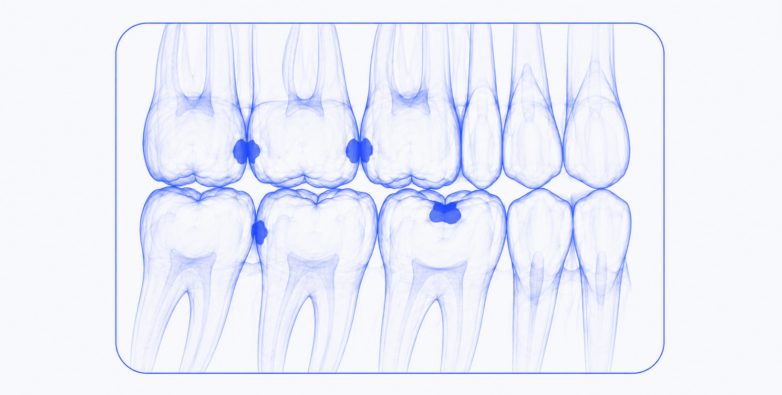 Caries Classification