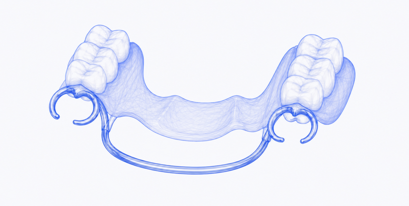 Removable Partial Dentures