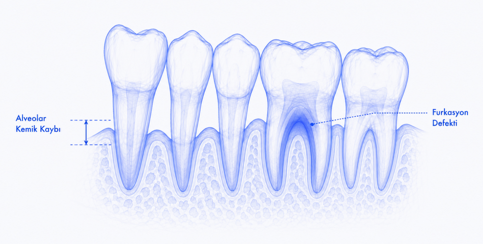 Alveolar Bone Loss and Furcation Defects
