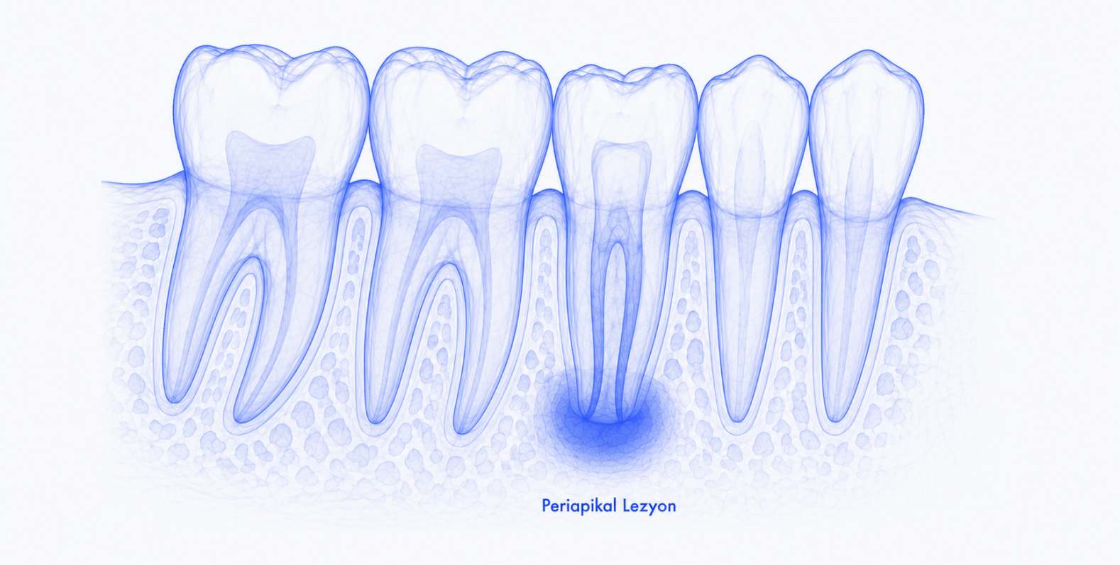 Periapical Lesions